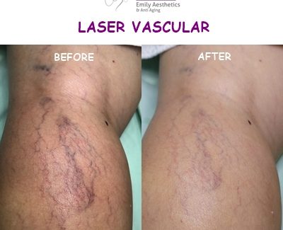 Laser Vascular – E3A Clinic