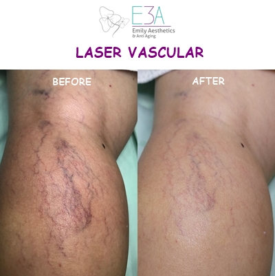 Laser Vascular – E3A Clinic