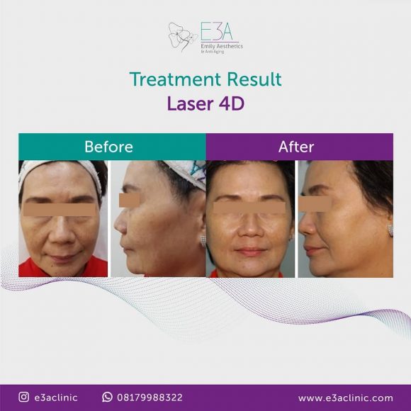 Atasi Wajah Kendur Akibat Aging dengan Keajaiban Laser 4D di E3A Clinic Jakarta Timur