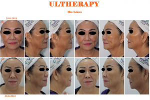 before after treatment Ultherapy