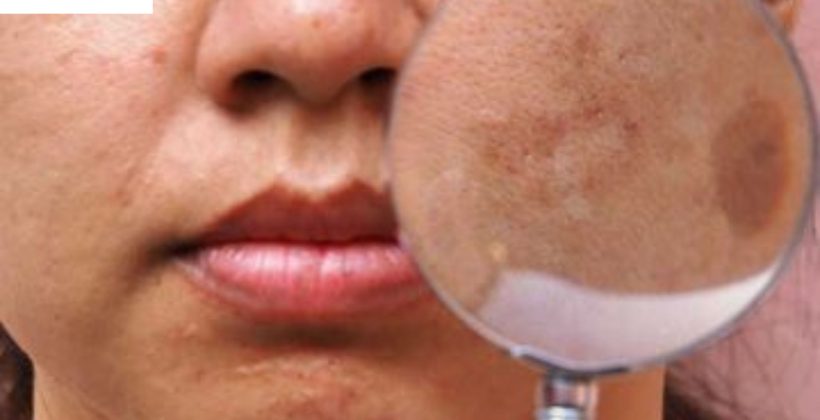 Meso Melasma Solusi Efektif Atasi Bintik Hitam di Wajah