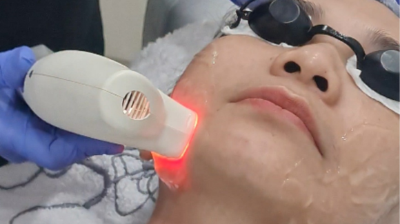 Bekas Jerawat Membandel dan Kemerahan Bikin Jengkel? Kenalan dengan Photoglow Radiance