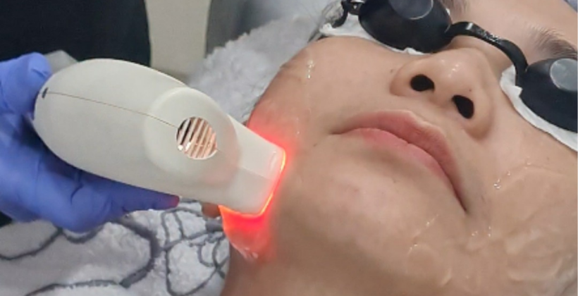 Bekas Jerawat Membandel dan Kemerahan Bikin Jengkel? Kenalan dengan Photoglow Radiance