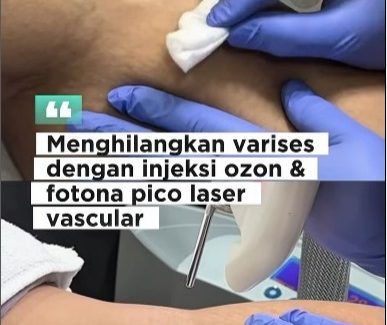 Solusi Ganda untuk Varises: Hilangkan dengan Ozone dan Laser Fotona di E3A Clinic Solusi Ganda untuk Varises: Hilangkan dengan Ozone dan Laser Fotona di E3A Clinic