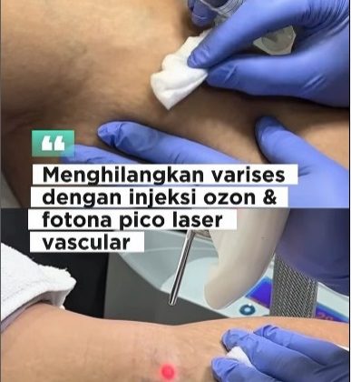 Solusi Ganda untuk Varises: Hilangkan dengan Ozone dan Laser Fotona di E3A Clinic Solusi Ganda untuk Varises: Hilangkan dengan Ozone dan Laser Fotona di E3A Clinic