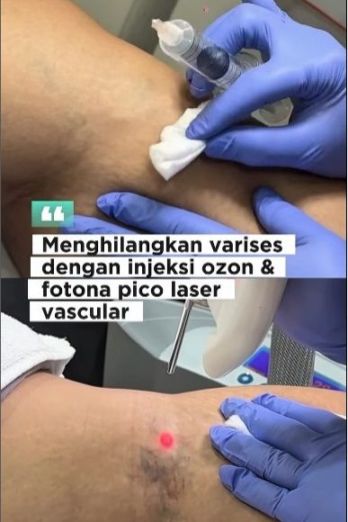 Solusi Ganda untuk Varises: Hilangkan dengan Ozone dan Laser Fotona di E3A Clinic