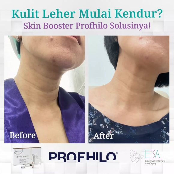 Leher Kendur dan Berkerut? Profhilo Solusinya!