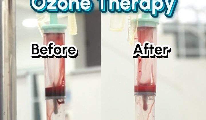 Terapi Ozon Cherry Red: Mengapa Penting untuk Imunitas dan Vitalitas Tubuh?