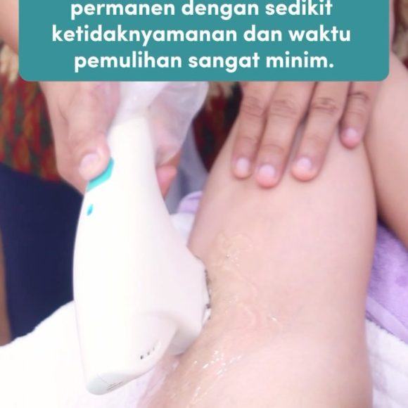 Dapatkan Ketiak Mulus Bebas Repot dengan Underarm Hair Removal di E3A Clinic