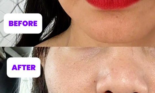 Profhilo Structura: Solusi Tepat untuk Wajah Kendur dan Kehilangan Volume Profhilo Structura: Solusi Tepat untuk Wajah Kendur dan Kehilangan Volume