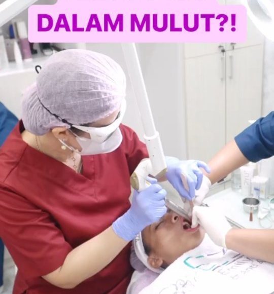 Rahasia Wajah Kencang Tanpa Operasi: Mengenal SmoothLiftin (Laser dari Dalam Mulut) di E3A Clinic