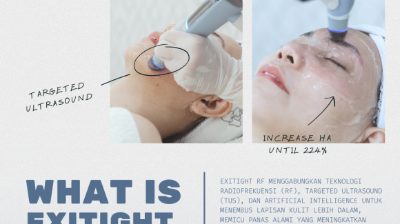 Wujudkan Wajah Kencang dan Kontur Tegas dengan ExiTide RF by Exion, Hanya di Klinik E3A! Wujudkan Wajah Kencang dan Kontur Tegas dengan ExiTide RF by Exion, Hanya di Klinik E3A!