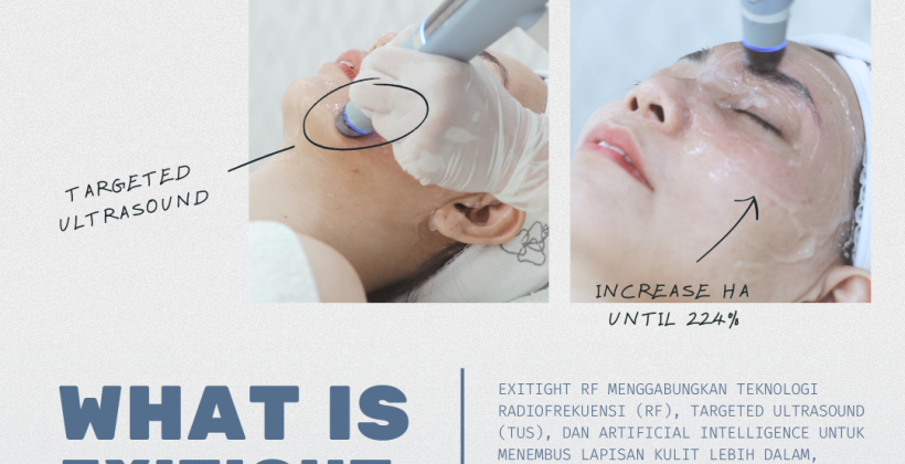 Wujudkan Wajah Kencang dan Kontur Tegas dengan ExiTide RF by Exion, Hanya di Klinik E3A! Wujudkan Wajah Kencang dan Kontur Tegas dengan ExiTide RF by Exion, Hanya di Klinik E3A!