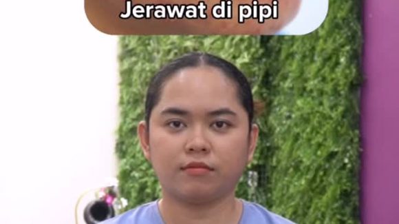 Apa Pesan di Balik Jerawatmu? Yuk, Kenali Tandanya! 🔍✨