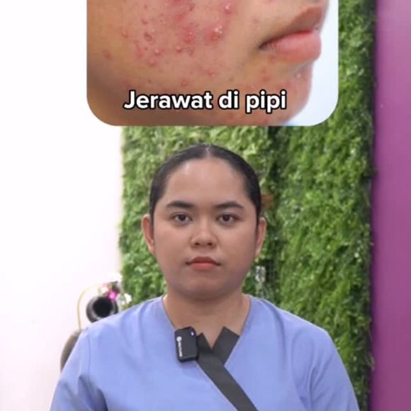 Apa Pesan di Balik Jerawatmu? Yuk, Kenali Tandanya! 🔍✨