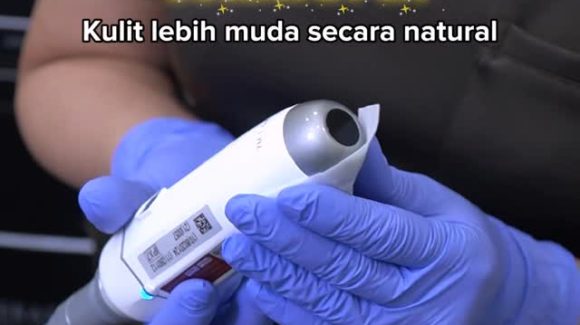 Mengenal Cool Pen Treatment: Solusi Tirus dan Kencang Tanpa Rasa Sakit hingga ke Sudut Wajah
