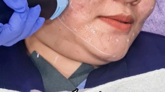 Coolstamp di E3A Clinic: Rahasia Kulit Kencang, Tirus, dan Glowing Tanpa Rasa Sakit