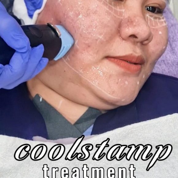 Coolstamp di E3A Clinic: Rahasia Kulit Kencang, Tirus, dan Glowing Tanpa Rasa Sakit
