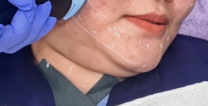 Coolstamp di E3A Clinic: Rahasia Kulit Kencang, Tirus, dan Glowing Tanpa Rasa Sakit